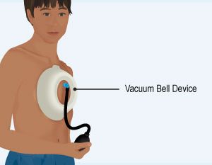 Vacuum Bell Device